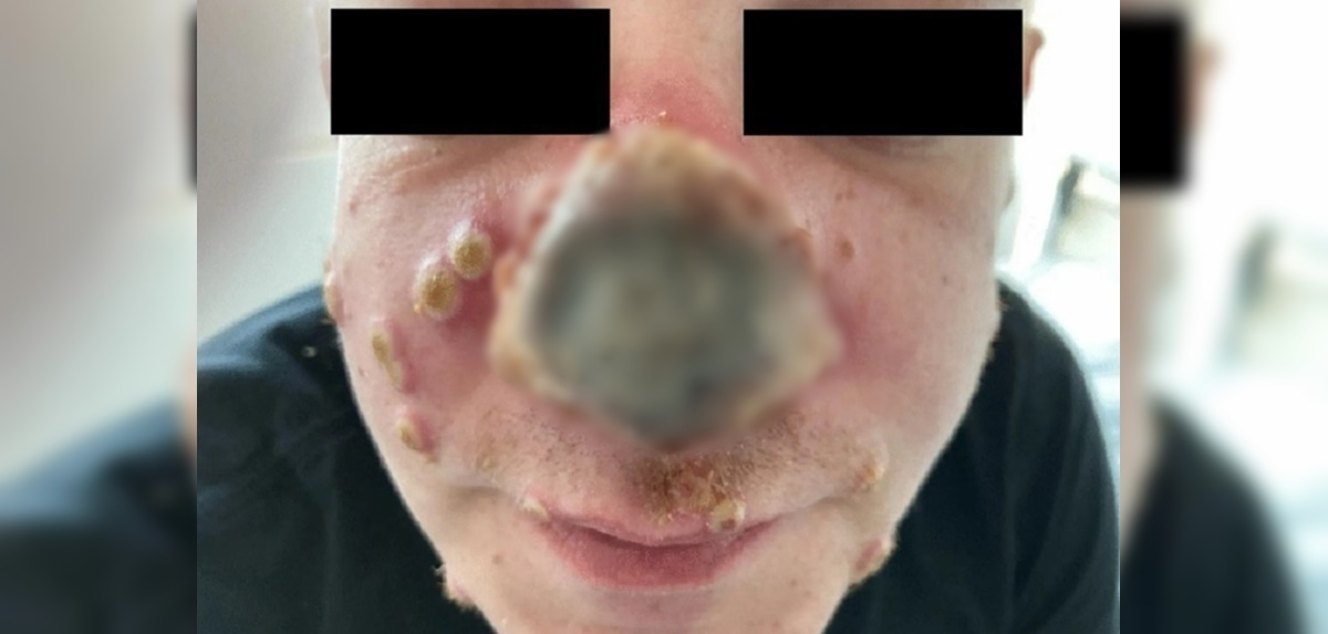 El caso de viruela del mono que impacta en Alemania: ¿por qué derivó en necrosis?