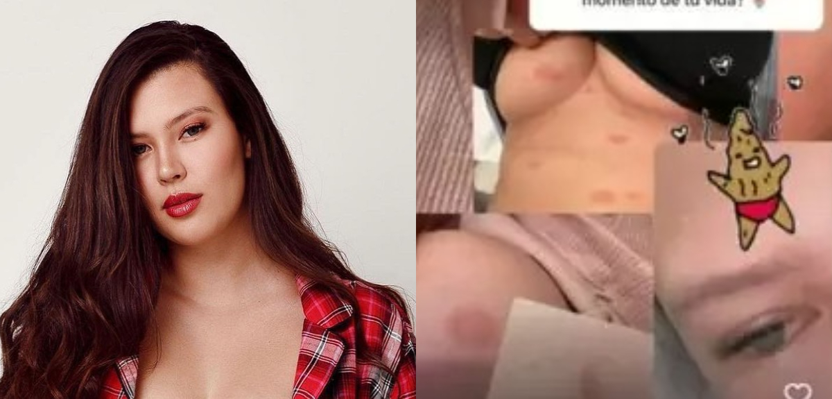 Pitiriasis rosada: causas y tratamiento de la enfermedad a la piel que afectó a Michelle Carvalho