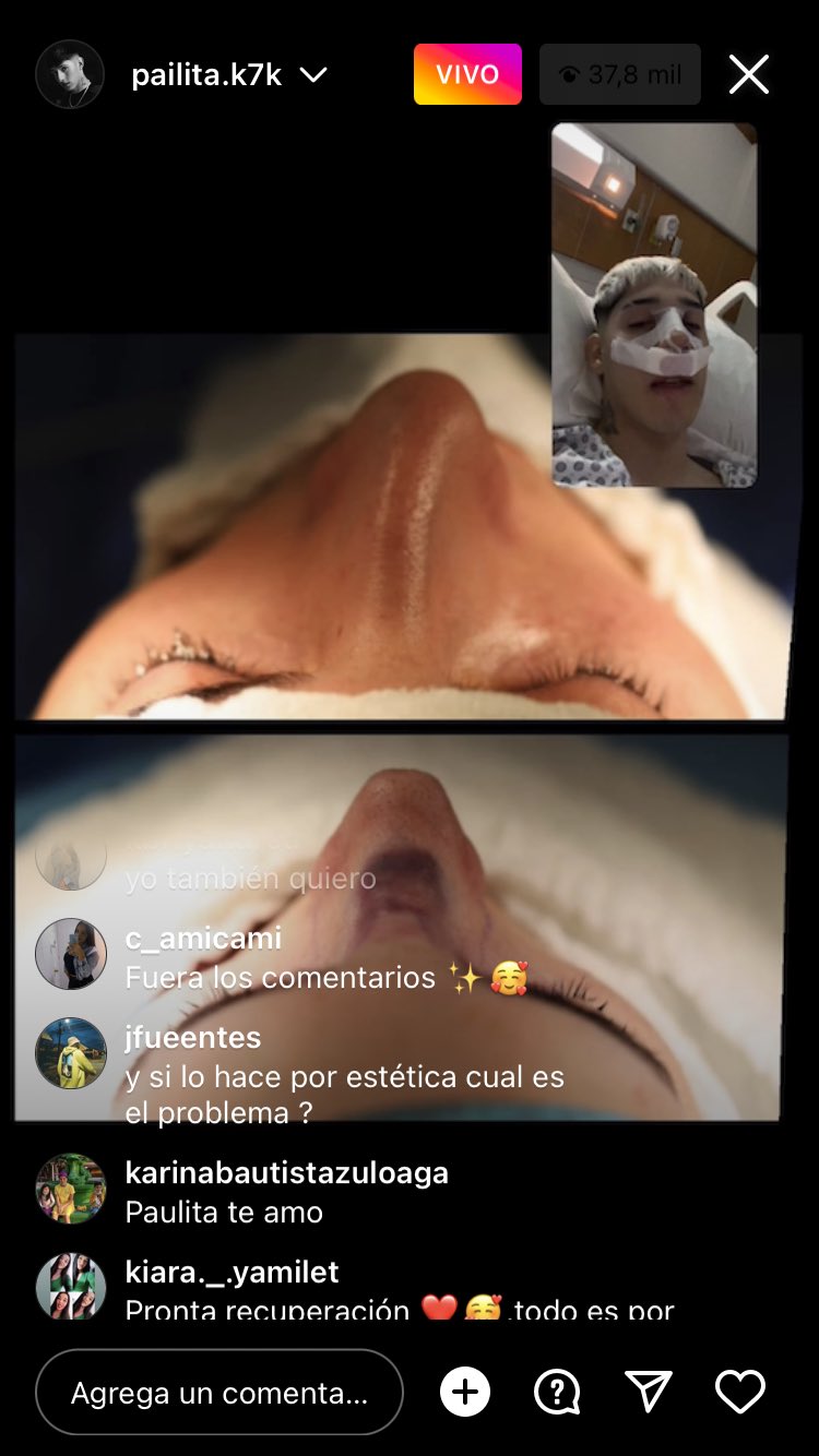 Pailita mostró cómo quedó su nariz tras operación.