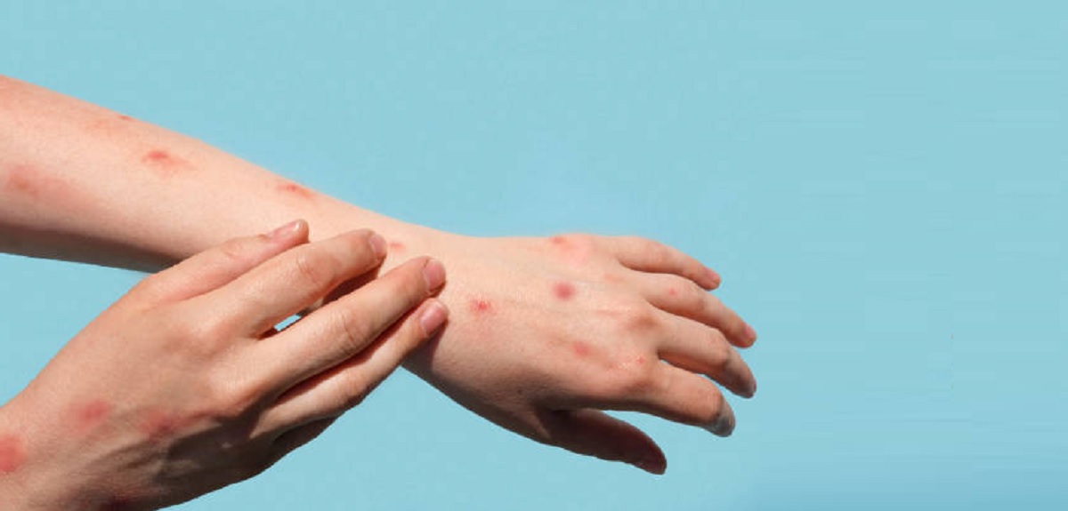 Identifican cambios en síntomas de la viruela del mono: compararon brotes iniciales y los de ahora