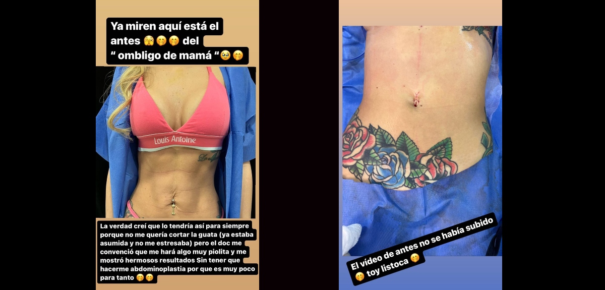 ombligo Coté López