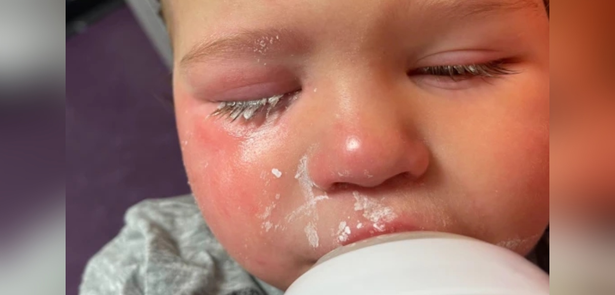 Niño terminó hospitalizado luego de que cuidadora del jardín le echara pegamento para uñas en el ojo