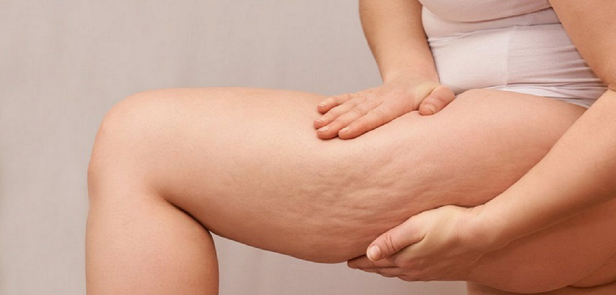 ¿La celulitis es solo un problema estético o es signo de enfermedad? 4 tips para prevenirla