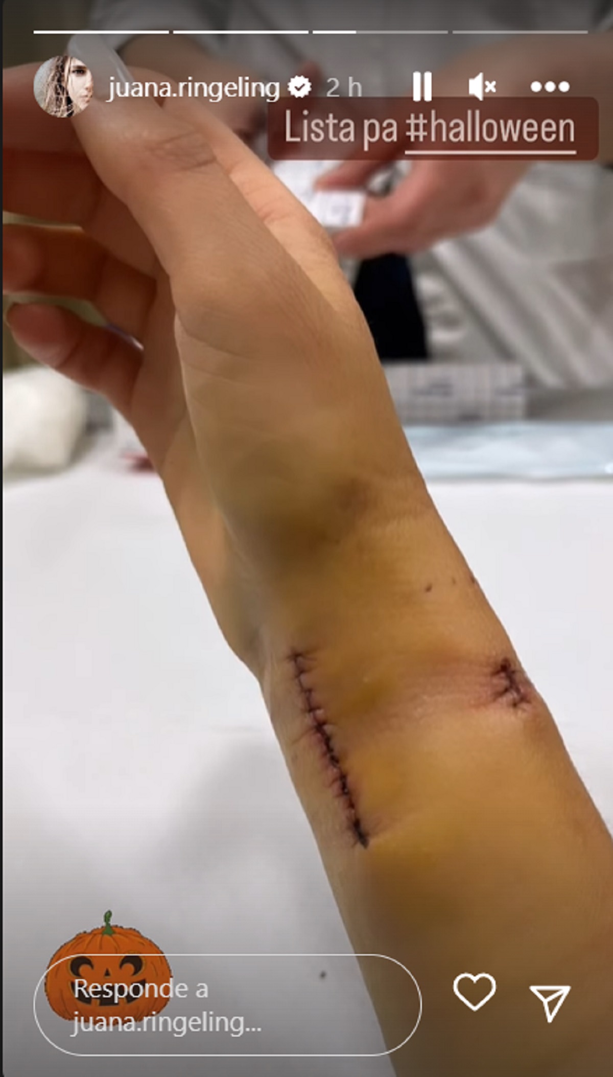 Muñeca de Juanita Ringeling tras fractura