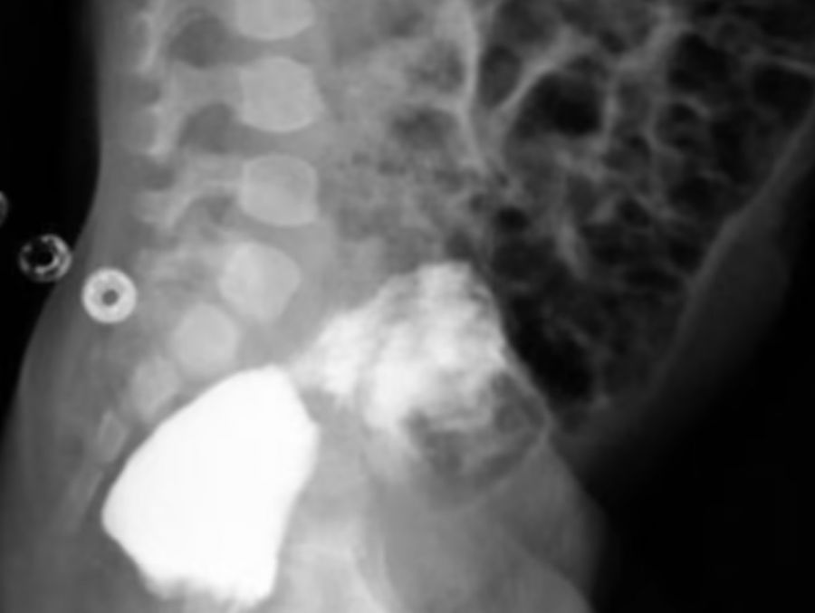 Radiografía de bebé iraní que nació sin pene