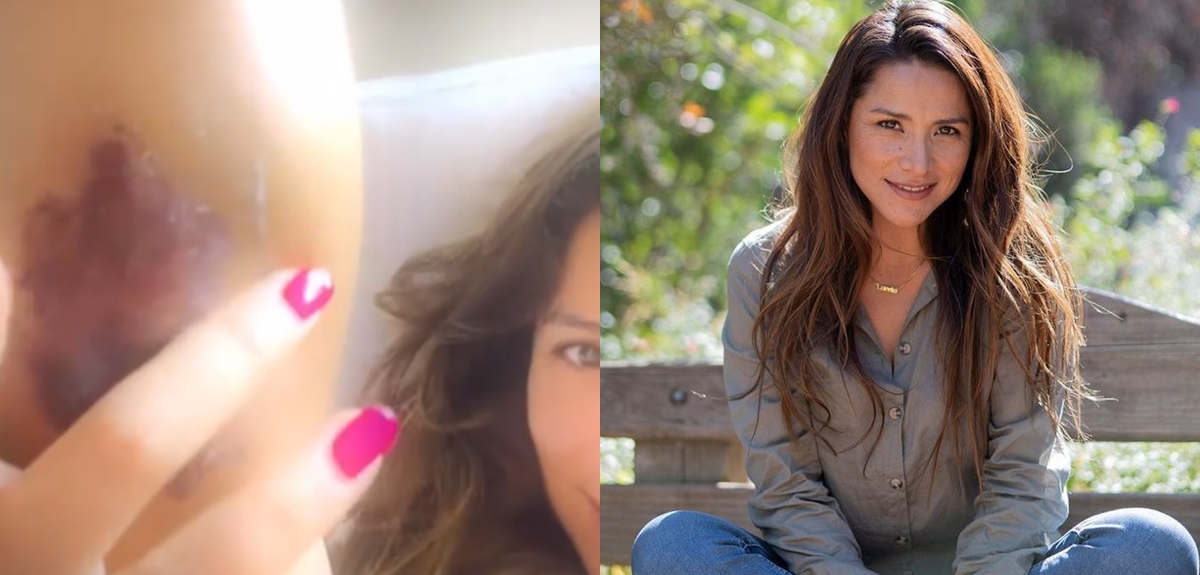 Loreto Aravena mostró evolución de su herida en la pierna tras ser picada por una araña de rincón