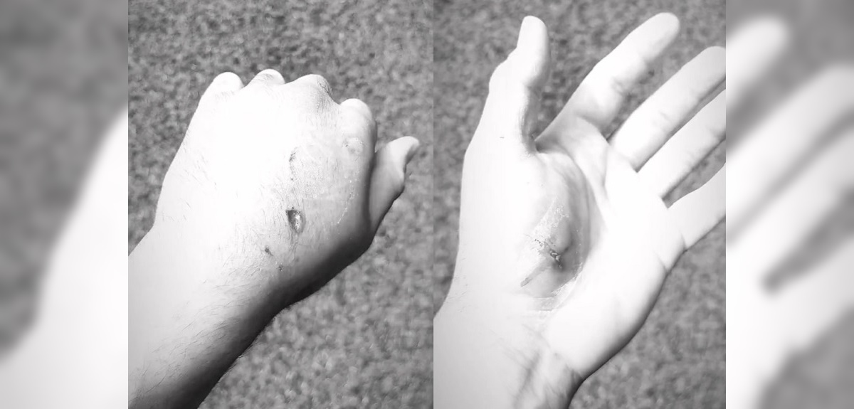 Heridas mordida perro Alvaro Ballero