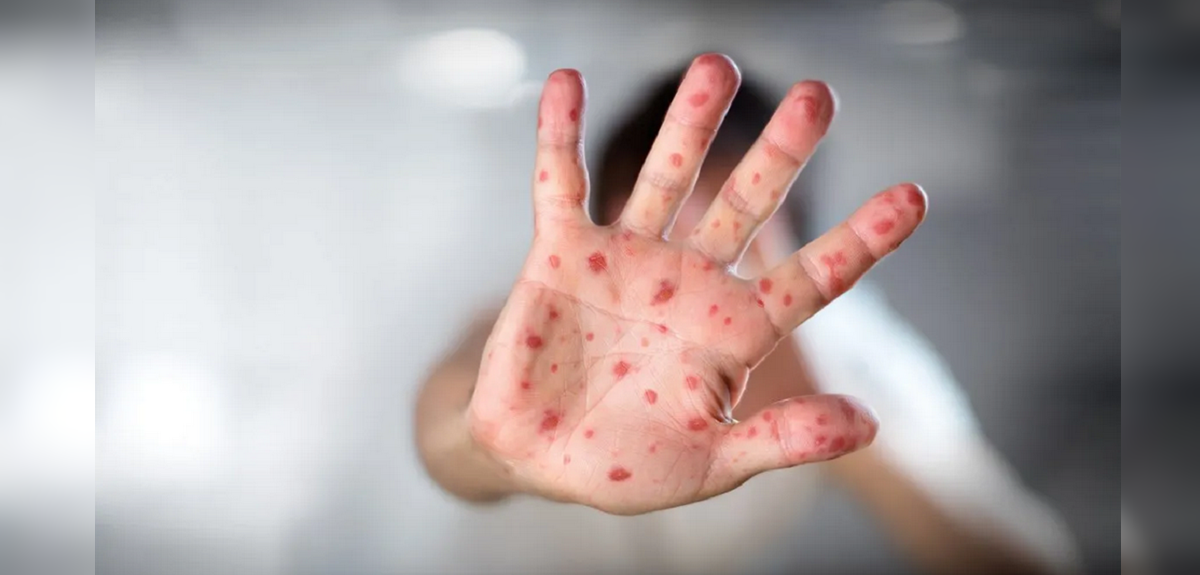 Ministerio de Salud confirmó primer fallecimiento en Chile por viruela del mono