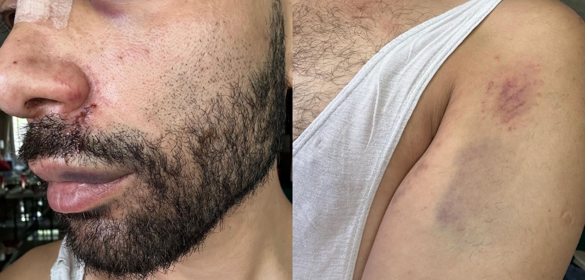 Agresión a Luz Violeta