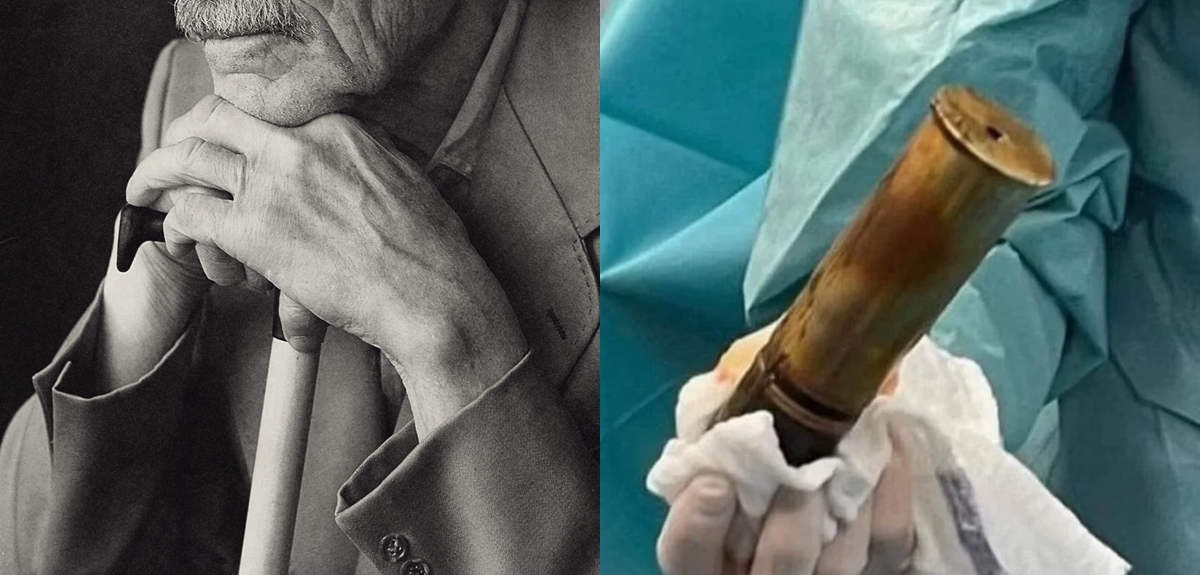 Anciano llegó a hospital con proyectil de Primera Guerra Mundial en el ano: obligó a evacuar recinto