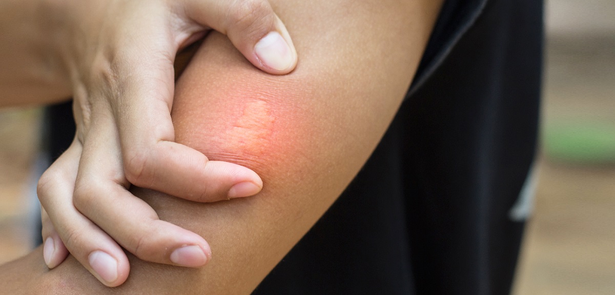Temporada de picaduras de insectos: sepa cómo evitar la picazón y el dolor