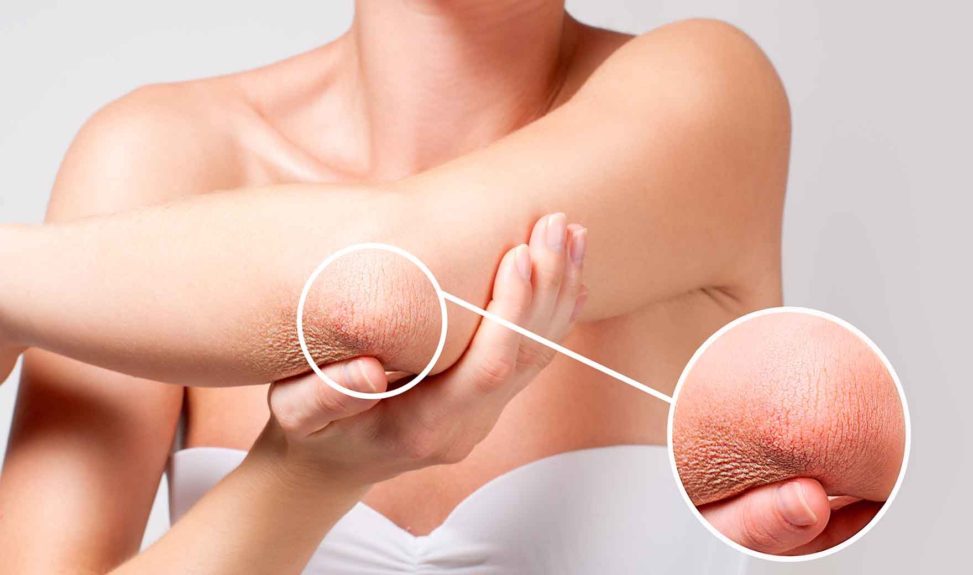 codos y rodillas resecos