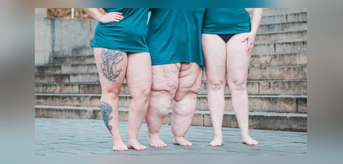 Lipedema: la enfermedad confundida con la obesidad que tarda casi 20 años en ser diagnosticada