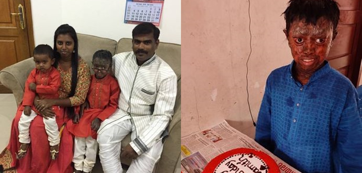 Niño de 12 años padece extraña enfermedad que le produce 