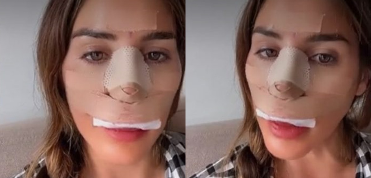 Fran Undurraga sufrió complicación tras cirugía en su nariz: encontraron material extraño y dañino