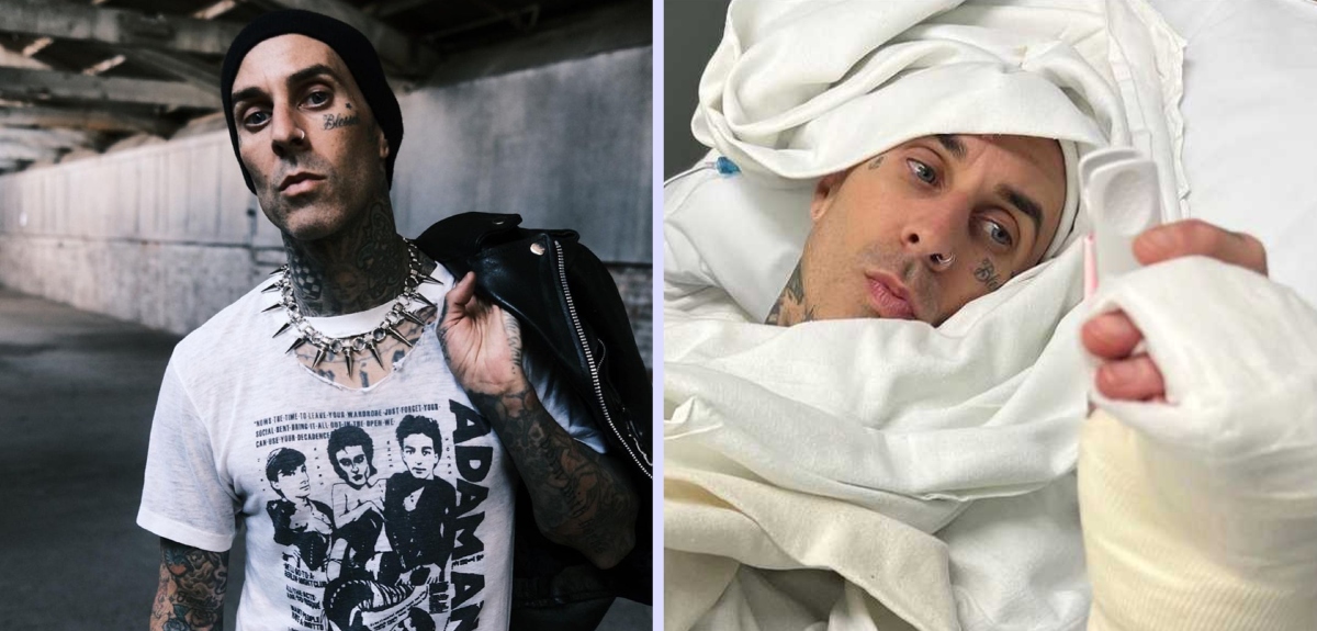 Travis Barker, baterista de Blink 182, mostró impactantes registros de su operación