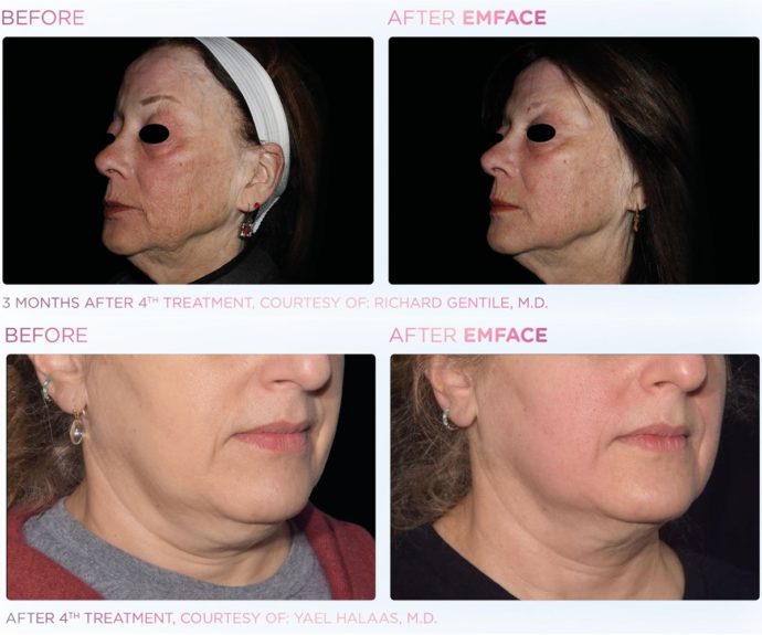 Llegó a Chile revolucionara máquina que rejuvenece el rostro sin agujas: Pamela Leiva inició proceso