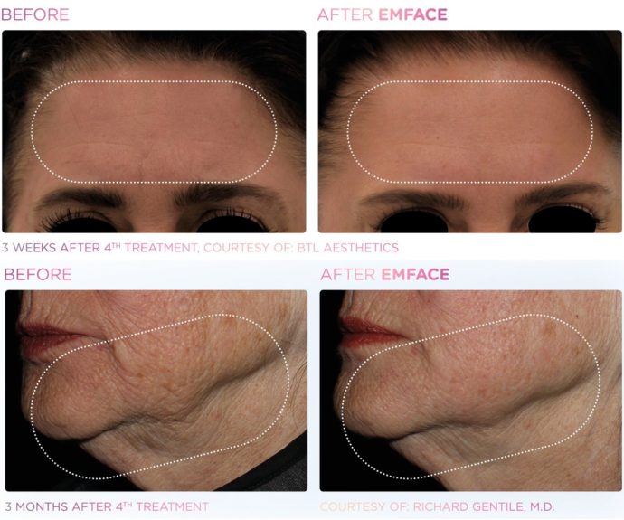 Llegó a Chile revolucionara máquina que rejuvenece el rostro sin agujas: Pamela Leiva inició proceso