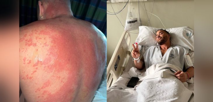 Prince Royce sufrió reacción alérgica