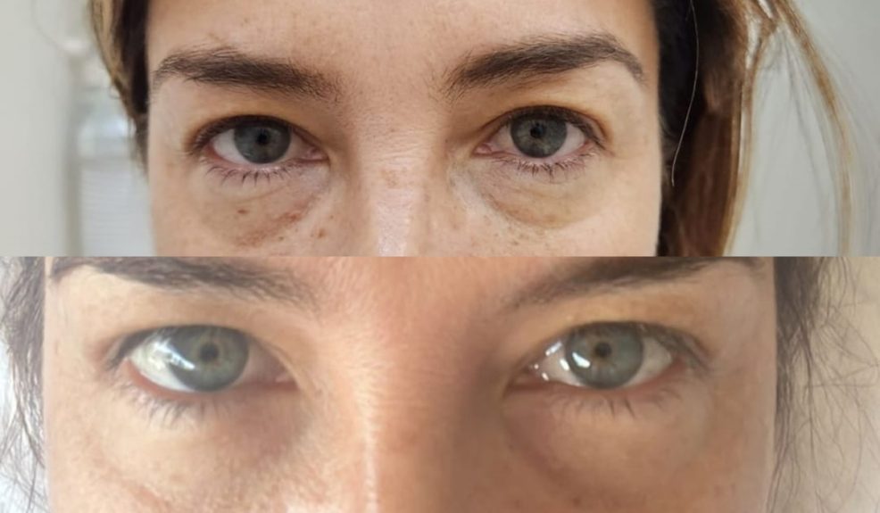 Pancha Merino recibió sus 50 años con tratamiento para rejuvenecer la mirada: conoce los resultados