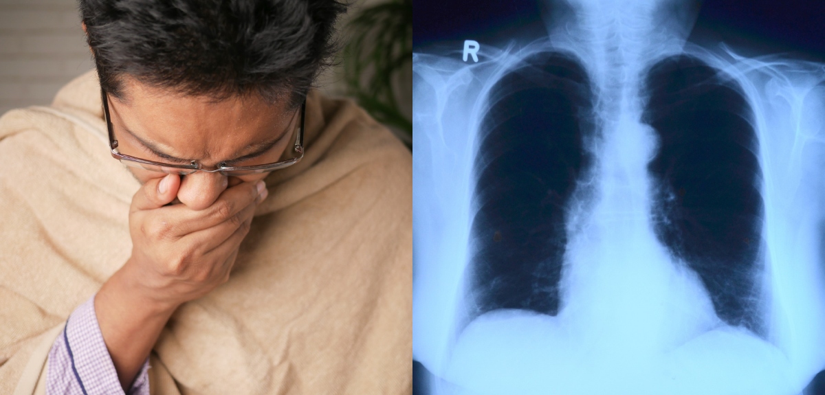 Tuberculosis: los síntomas y tratamiento de la enfermedad olvidada que va en aumento de incidencia