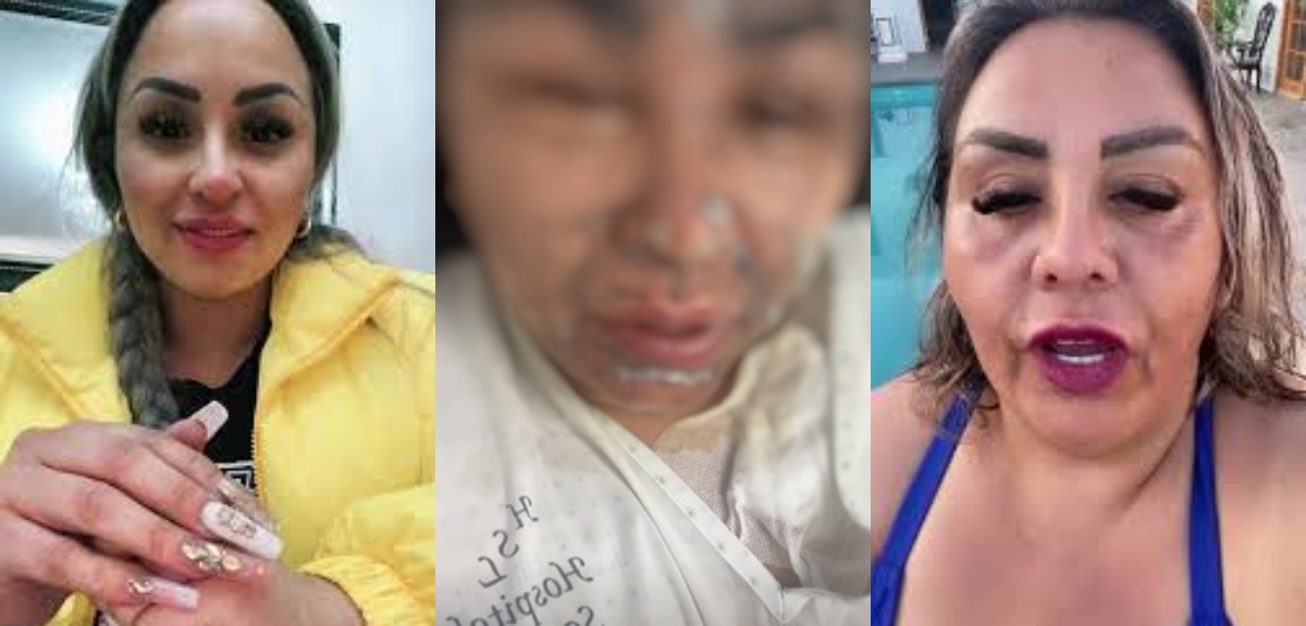 Influencers Shonay y Karencita Frías sufrieron graves quemaduras tras explosión de olla a presión