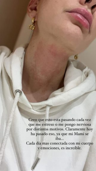 Aylén Milla mostró consecuencias del estrés en medio de su lucha contra el cáncer: "Es increíble"