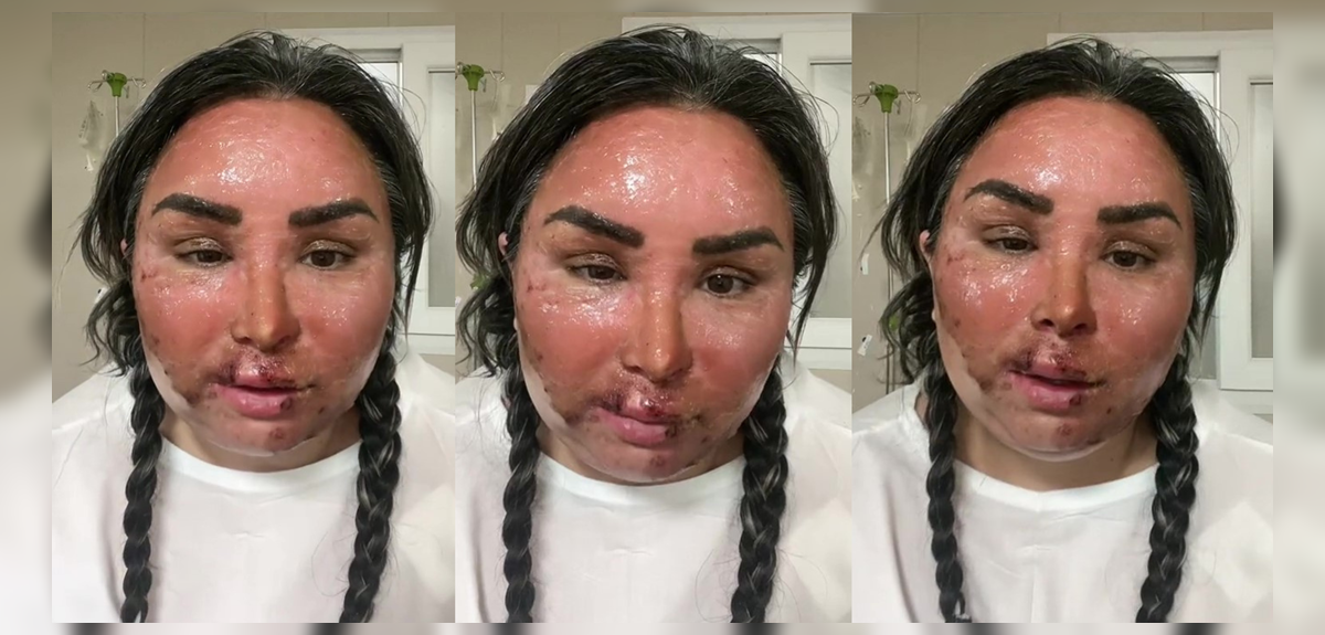 Influencer Karencita Frías mostró su recuperación tras sufrir complejo accidente con olla a presión