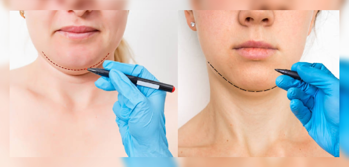 Lipopapada sin cirugía: una tendencia poco invasiva para evitar el 