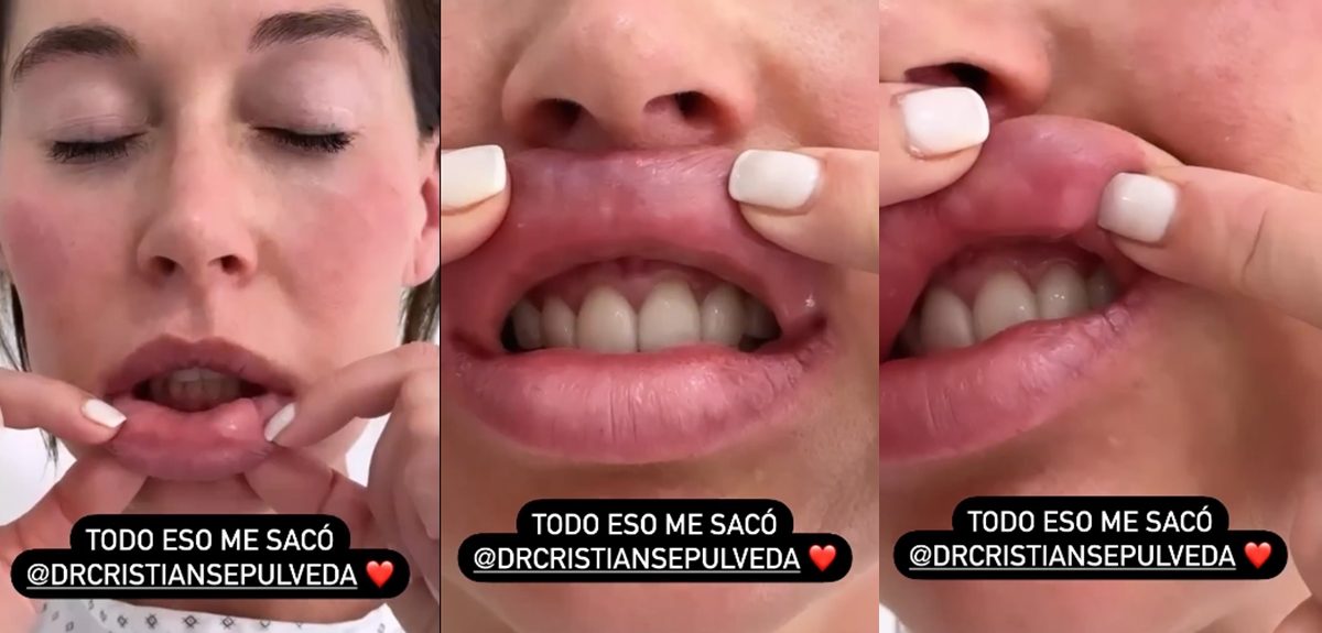 Vale Roth se sometió a importante operación: "Me daba mucho pudor, pero quiero que tomen conciencia"