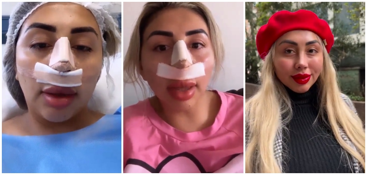 Naya Fácil muestra cómo quedó su nueva nariz y responde a críticas por resultado