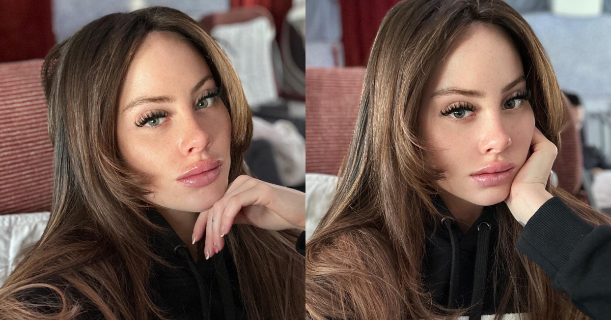 ¿Qué es y por qué se produce la alopecia? La afección que sufre Ignacia Michelson de Gran Hermano