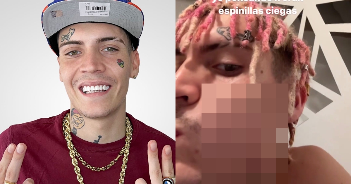 Marcianeke mostró bultos en su rostro tras inyectarse ácido hialurónico: 