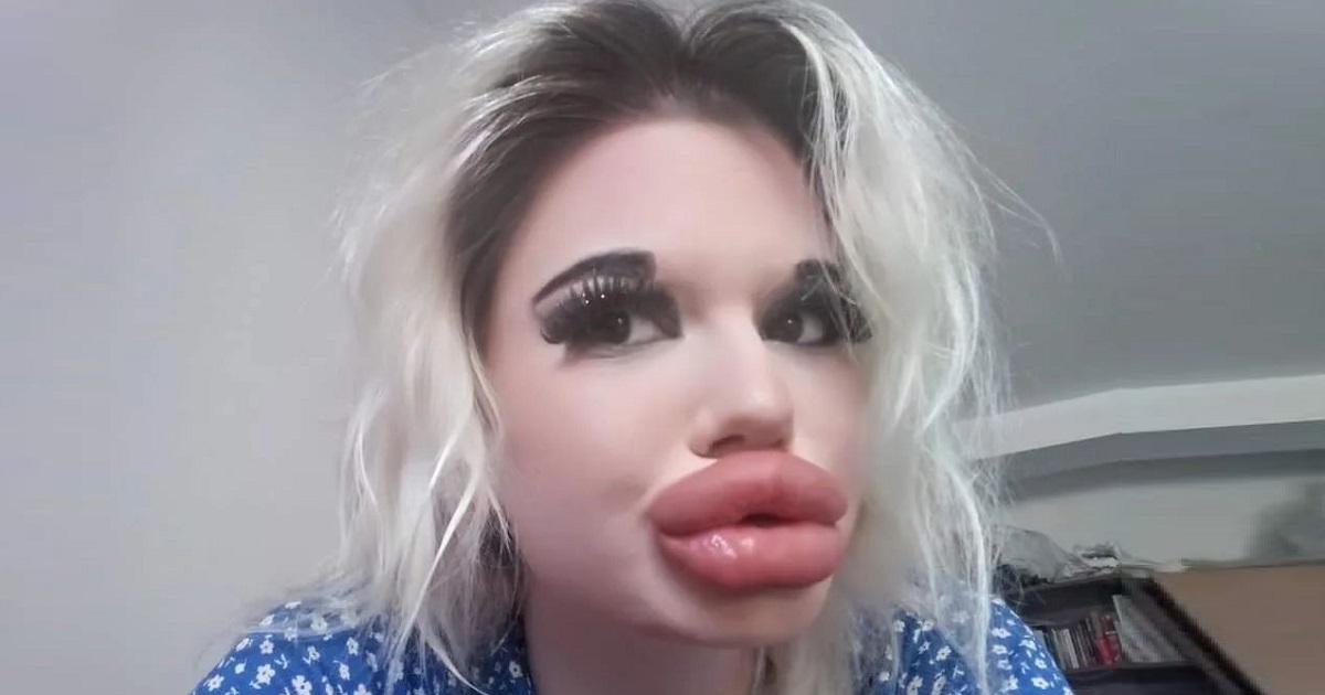 Mujer con los labios más grandes del mundo quiere seguir interviniendo su rostro y encontrar el amor