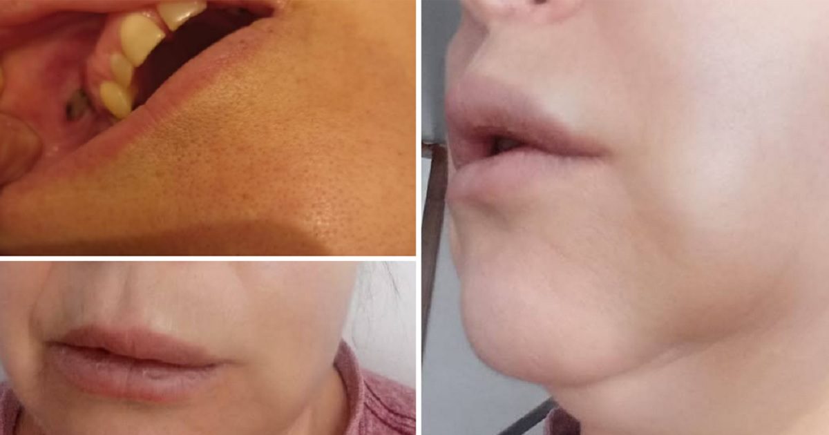 Paciente acusa negligencia clínica dental Concepción