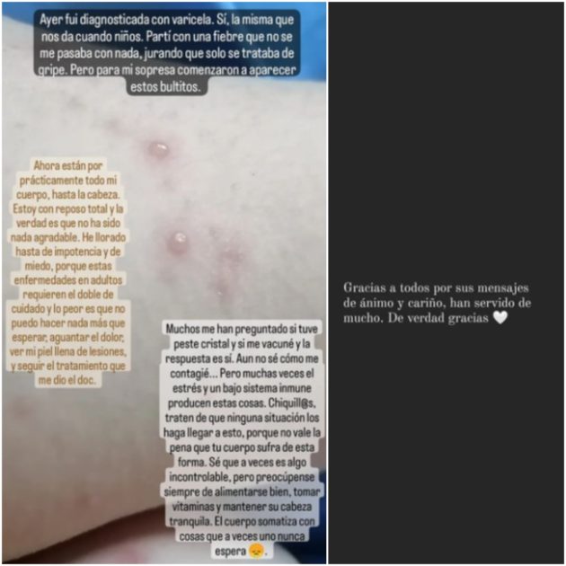 Paulina Padilla con varicela