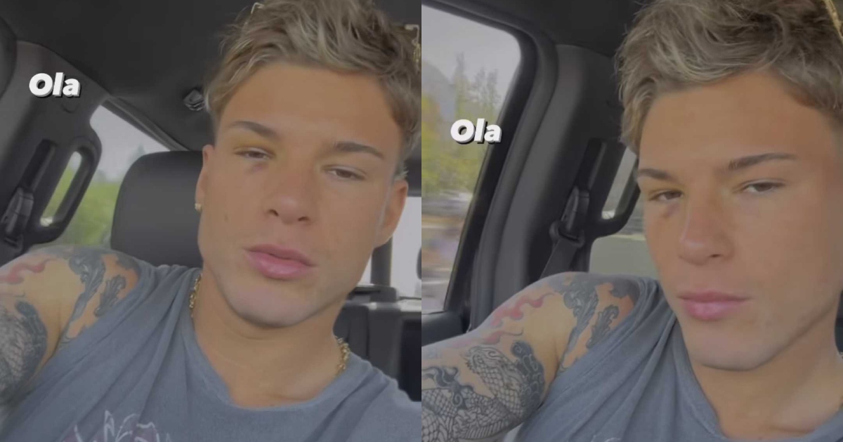 Raimundo Cerda reveló la razón por la que tiene moretones en su cara: 