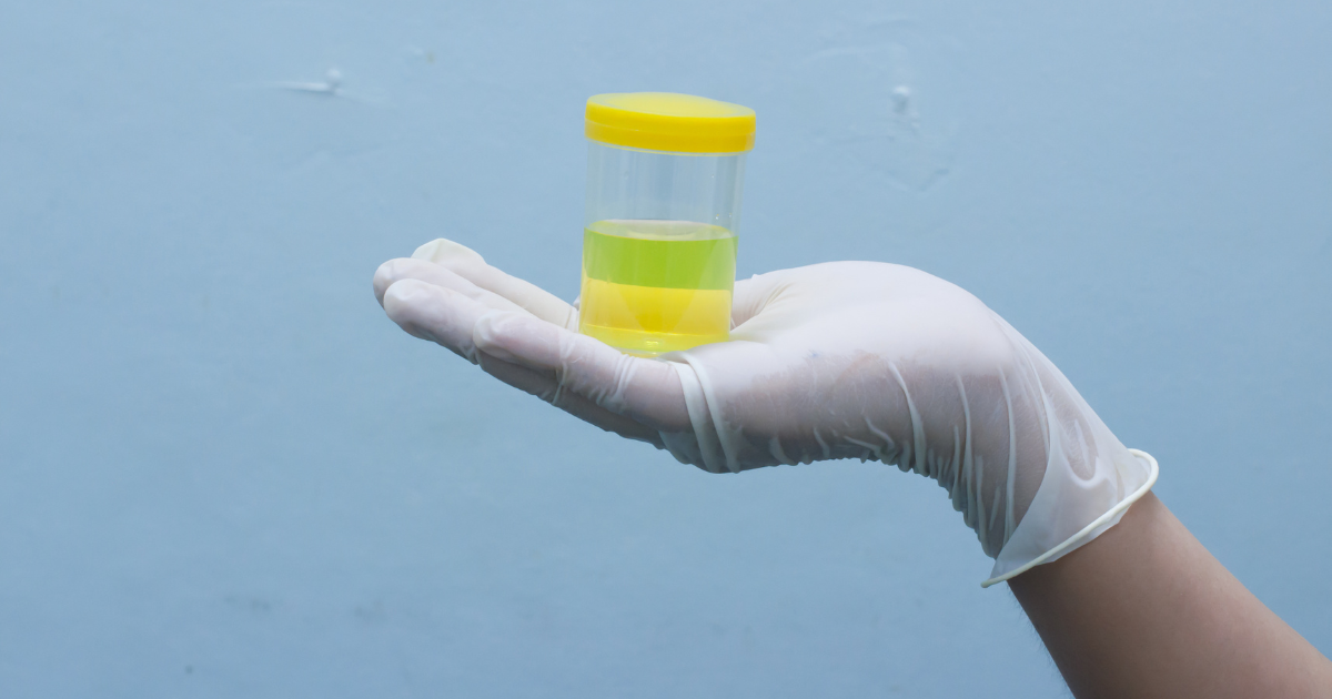 Descubren por qué la orina es amarilla