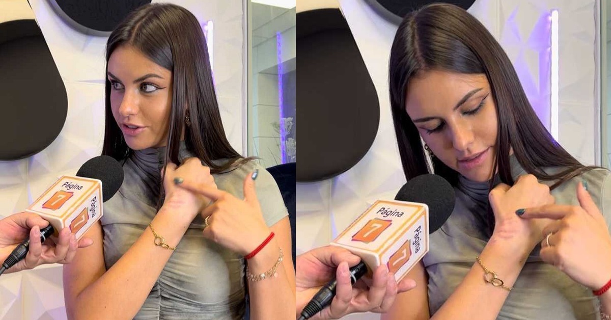 Emilia Dides mostró cicatriz que le dejó accidente automovilístico