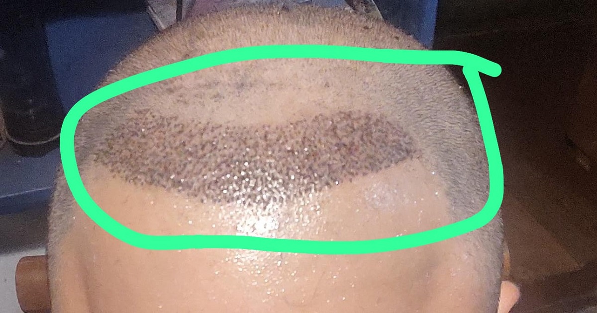 Juan Pablo Álvarez se sometió a implante capilar