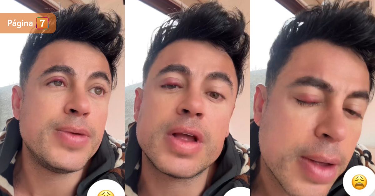 Bruno Zaretti reveló que tendrá que operarse tras afección en un ojo: “Dejen mi muñeco vudú”