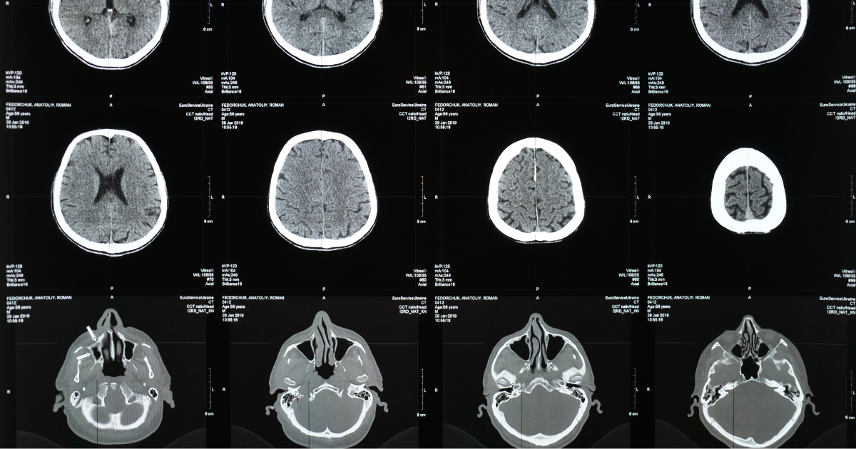 Escáneres detectan depresión: descubren seis tipos distintos y sus tratamientos efectivos