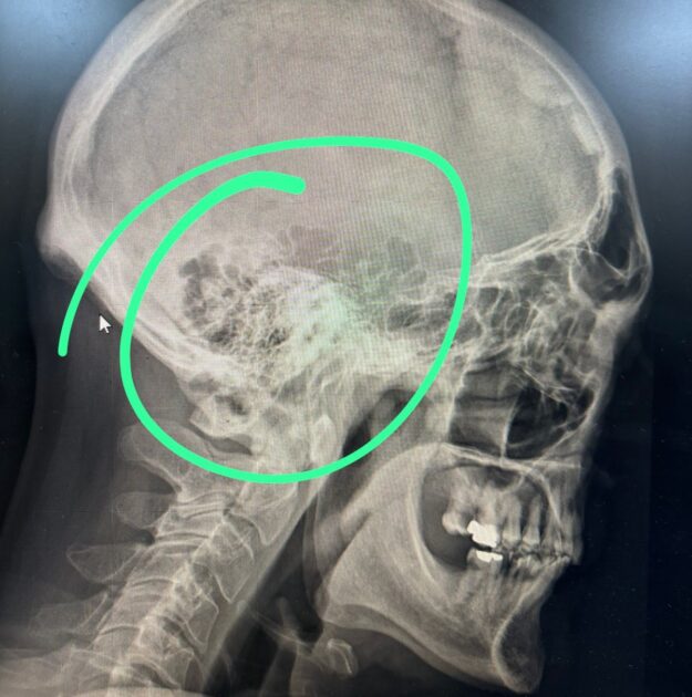 Marcelo Castillo, recordado Guatón Mamón de Tocando las Estrellas, sufrió accidente y quedó con TEC cerrado. 