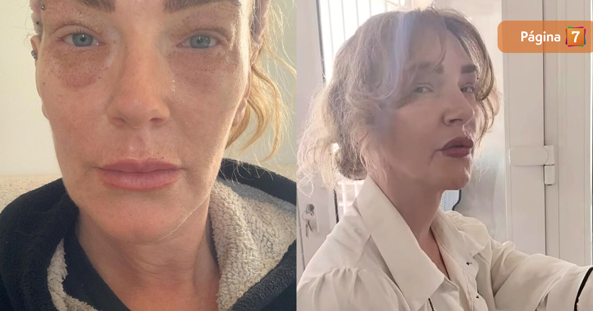 Catalina Pulido mostró evolución de su reciente retoque estético: 