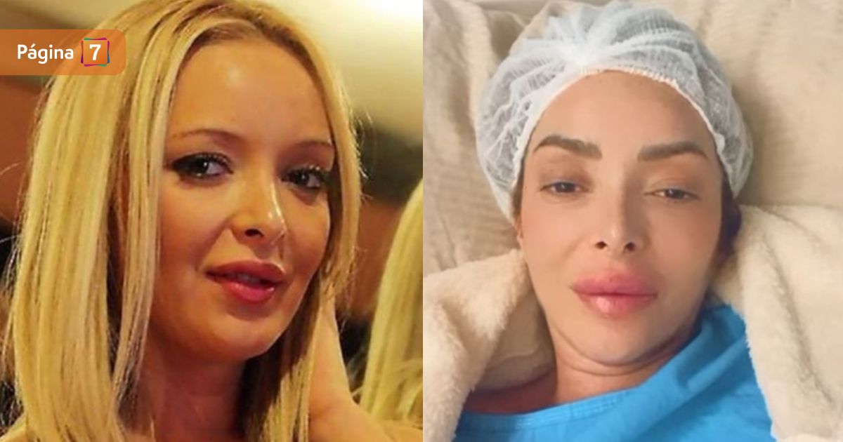 Ex Morandé con Compañía, Gisela Molinero, se sometió a cirugía para extraer metacril de su trasero