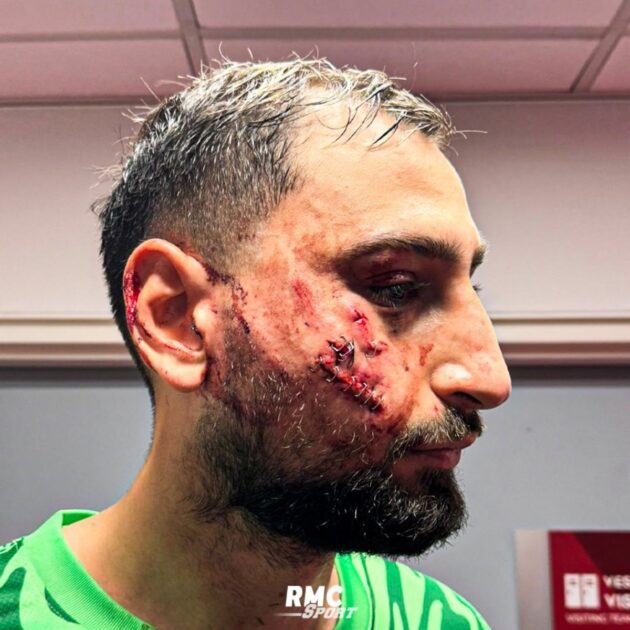 Así quedó el rostro de Gianluigi Donnarumma tras recibir terrible patada ante Mónaco