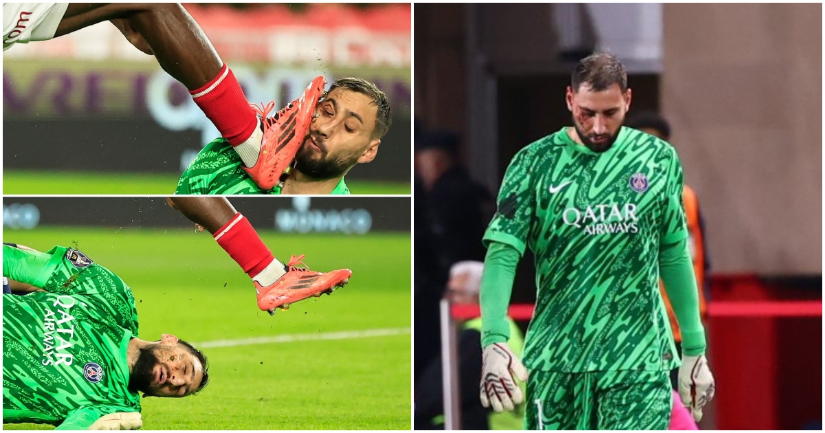 Así quedó el rostro de Gianluigi Donnarumma tras recibir terrible patada ante Mónaco