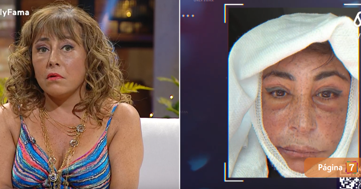 Helhue Sukni sorprendió al detallar operación a su rostro: percance la obligó a posponer cirugía