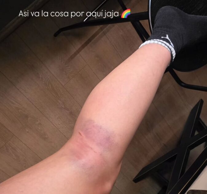 Kel Calderón mostró hematoma en su pierna tras caída a caballo