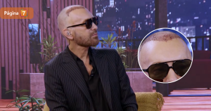 Jordi Castell explicó su curioso look tras cirugía de implante de pelo